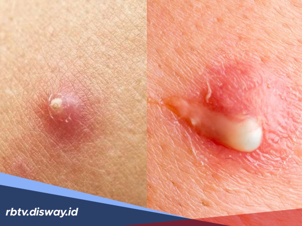 Rahasia Sembuh dari Bisul Tanpa Obat Kimia, dengan 5 Tanaman Obat Keluarga Ini