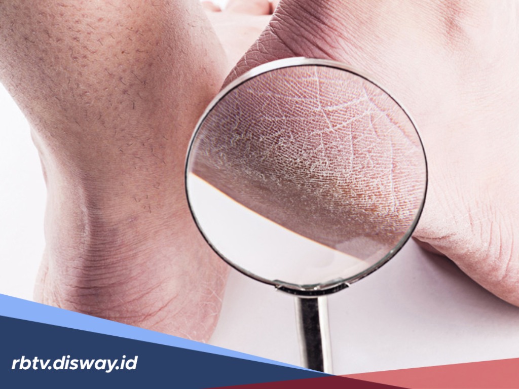Tanpa Dokter, Ini 10 Cara Mengatasi Kaki Pecah-pecah Secara Permanen