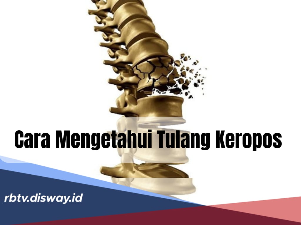 Cara Mengetahui Kamu Tulang Keropos atau Tidak, Kenali Gelaja Fisiknya