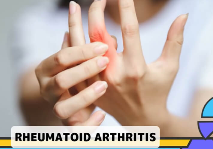  6 Penyebab Tangan Sering Kesemutan Kata dr Saddam Ismail, Bukan Sekadar Salah Posisi