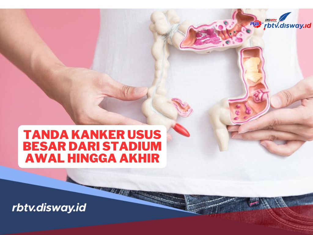 Kenali Tanda Kanker Usus Besar, Mulai dari Stadium Awal Hingga Staduim Akhir