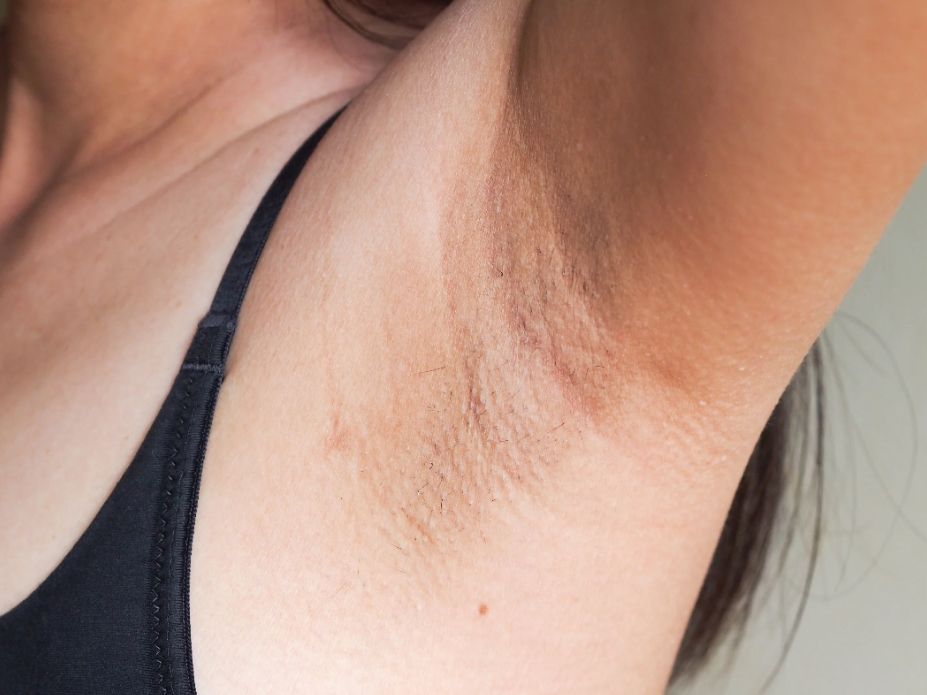 Malu Pakai Baju Lengan Pendek Karena Ketiak Hitam, Ini 7 Tanaman untuk Memutihkan Ketiak