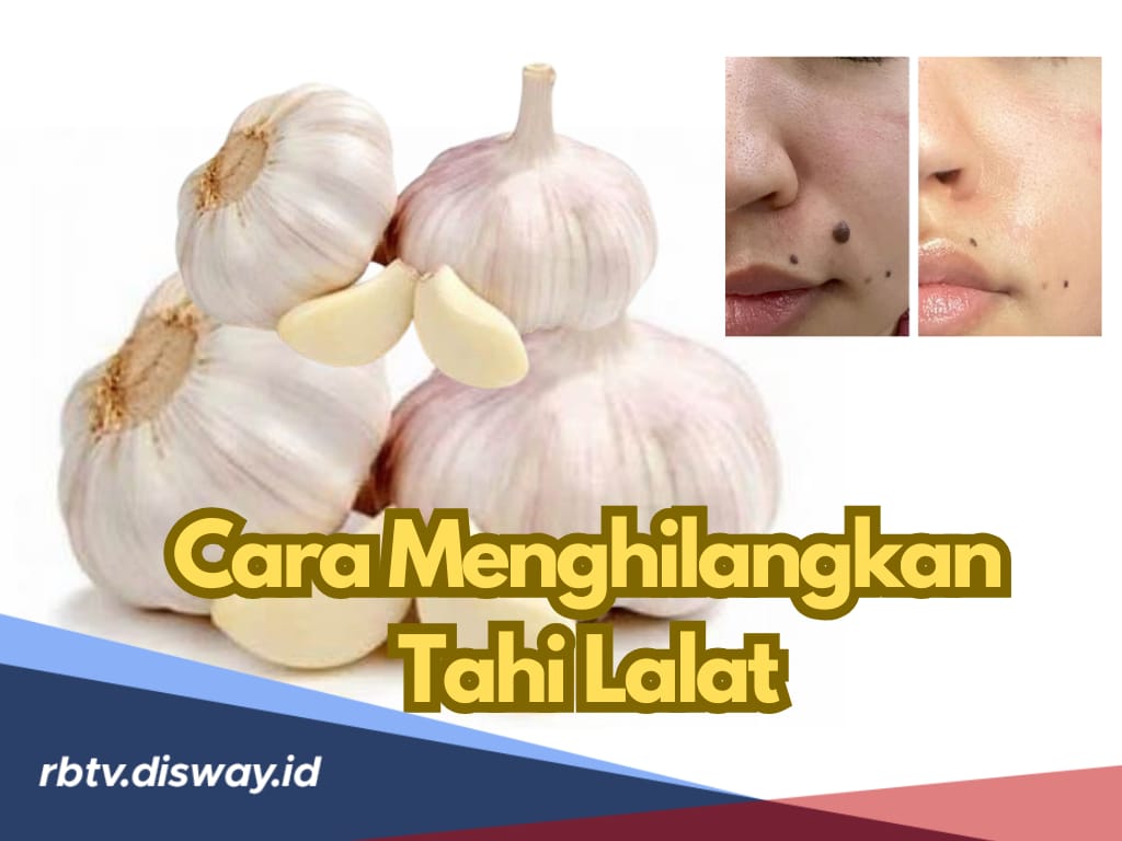 7 Cara Menghilangkan Tahi Lalat dengan Mudah dan Efektif, Salah Satunya Pakai Bawang Putih