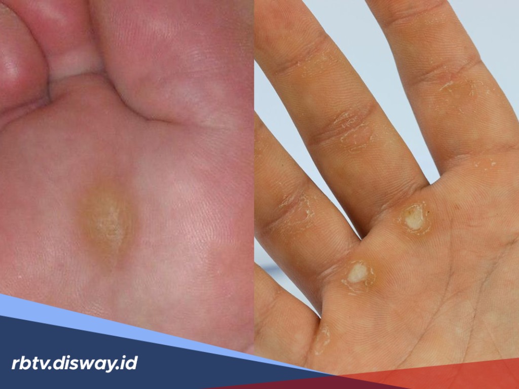 7 Cara Menghilangkan Kapalan di Kaki dan Tangan Secara Permanen