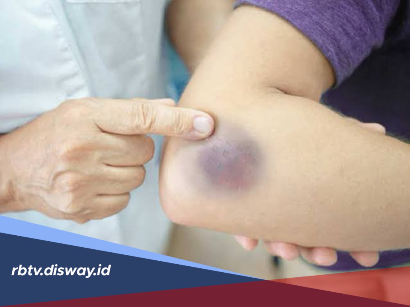 Mengenal Hematoma, Penyebab, Gejala, dan Cara Mengobatinya