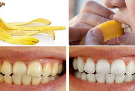 10 Cara Memutihkan Gigi Kuning dengan Bahan Alami, Salah satunya Pakai Kulit Pisang