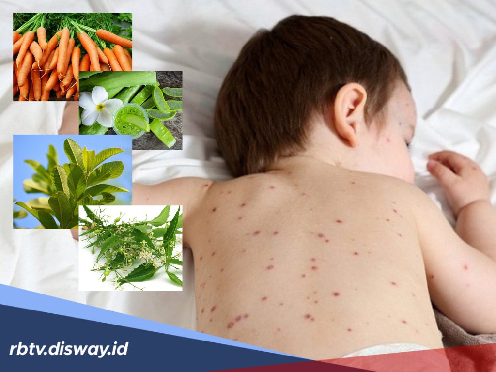 Gatal-gatal dan Perih Karena Cacar Air, Obati dengan 4 Tanaman Obat Keluarga Berikut 