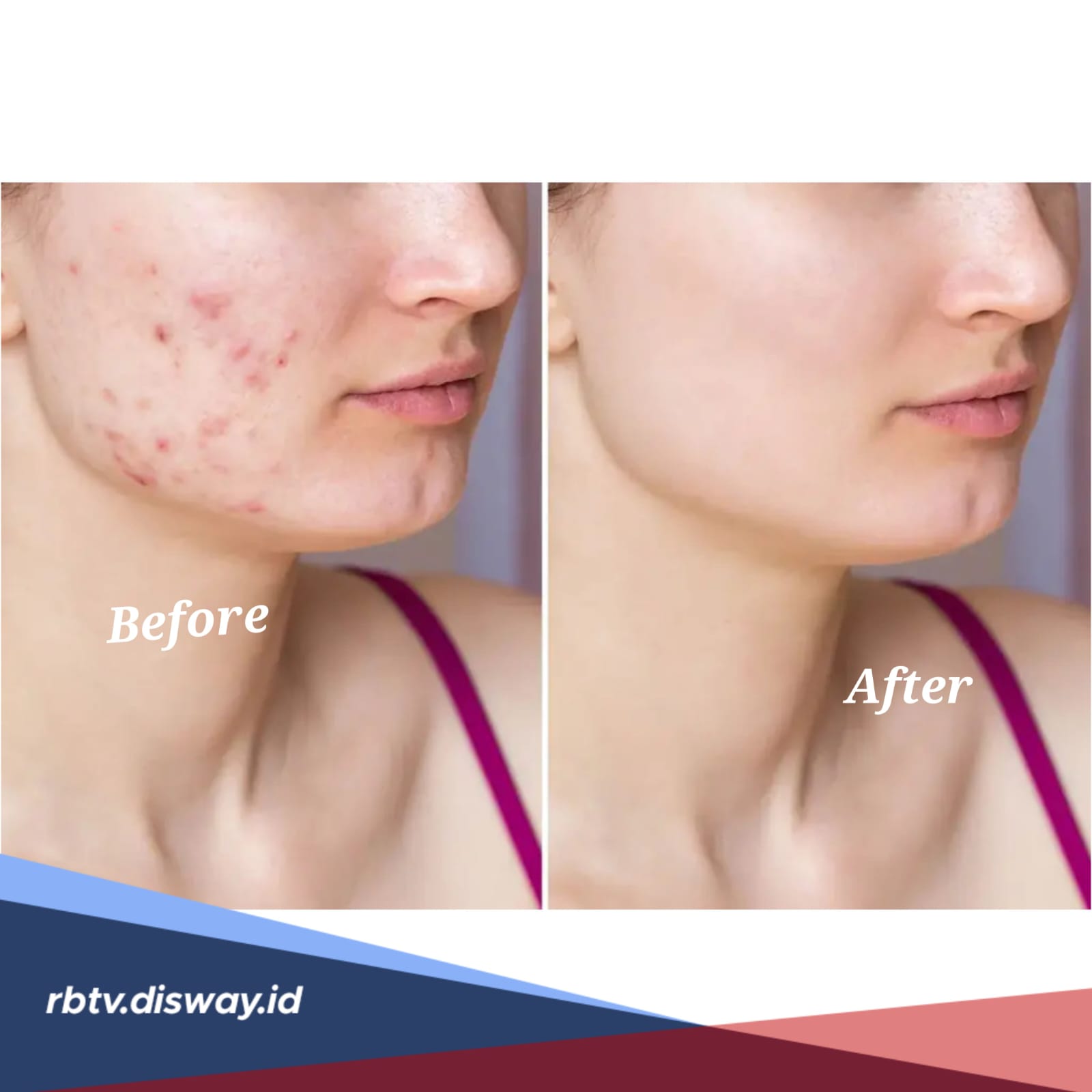 Ini Dia Cara Menghilangkan Bopeng Bekas Cacar, Dijamin Ampuh dan Sembuh