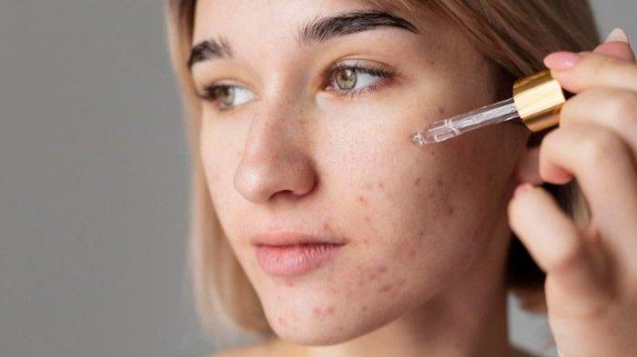 5 Skincare Korea untuk Kulit Berjerawat, Wajah Mulus Bebas Breakout