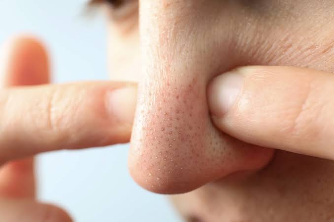 Cara Menghilangkan Pori-pori di Hidung Agar Terlihat Mulus, Gunakan 15 Tips Mudah Ini Saja