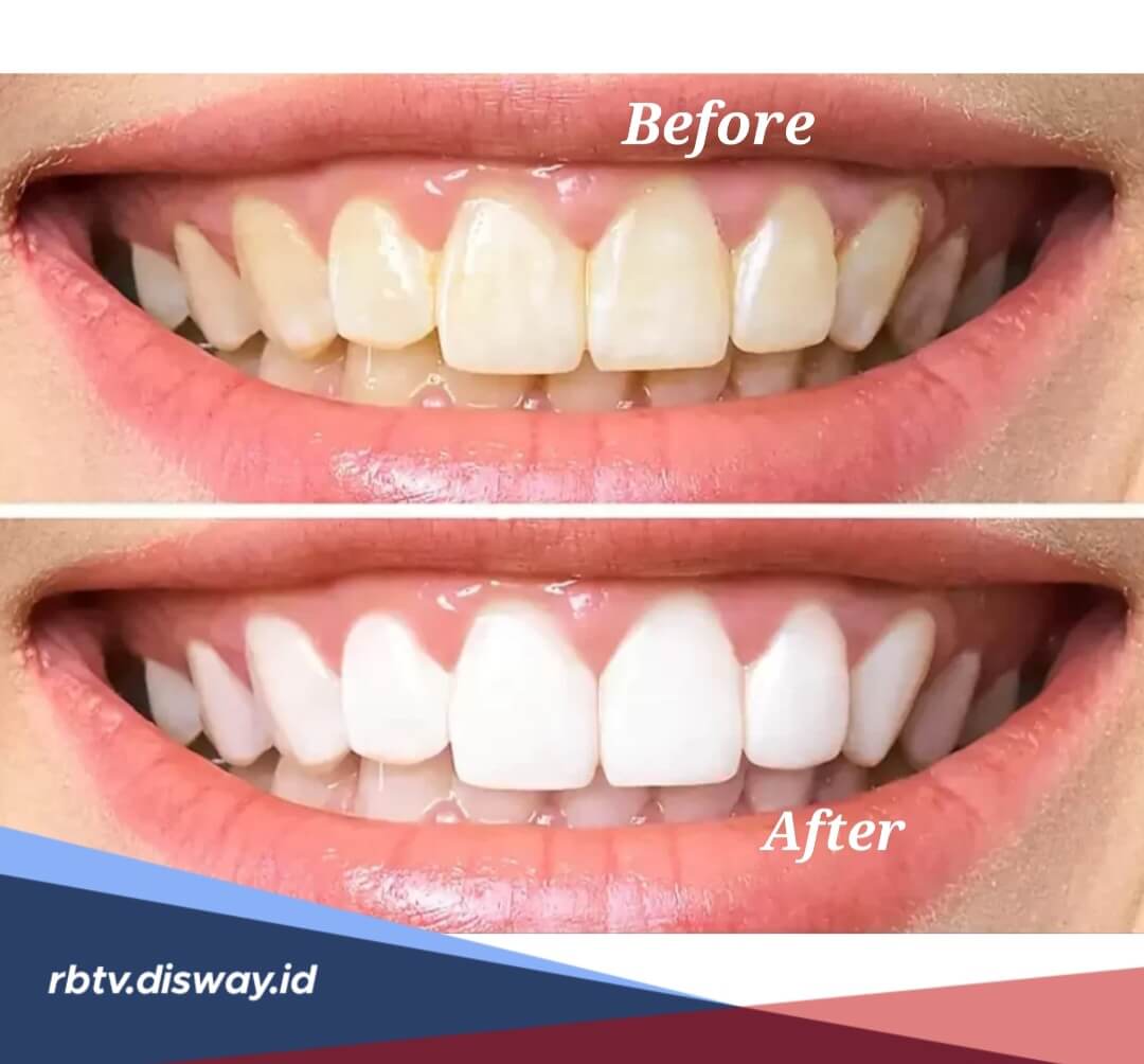 Tak Perlu Mahal, Begini Cara Memutihkan Gigi dengan Bahan Alami 