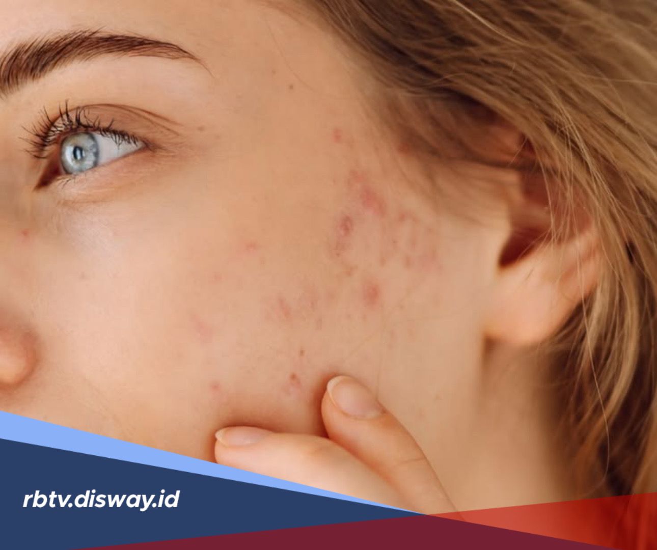 5 Cara Menghilangkan Bekas Jerawat dengan Bahan Alami