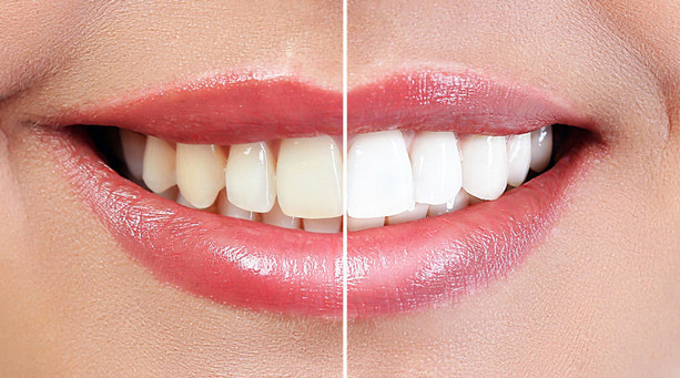 4 Cara Memutihkan Gigi yang Kuning, Salah Satunya Gunakan Cuka Sari Apel