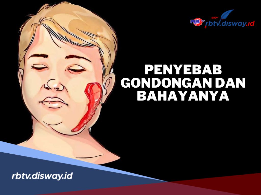 Waspada Penyakit Menular, Ini Penyebab Gondongan, Bisa Kehilangan Pendengaran