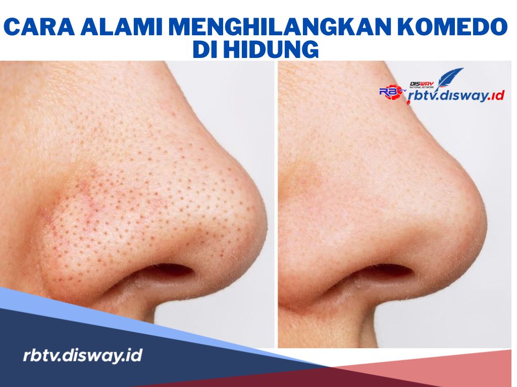 8 Cara Alami Menghilangkan Komedo di Hidung, Coba dan Rasakan Manfaatnya