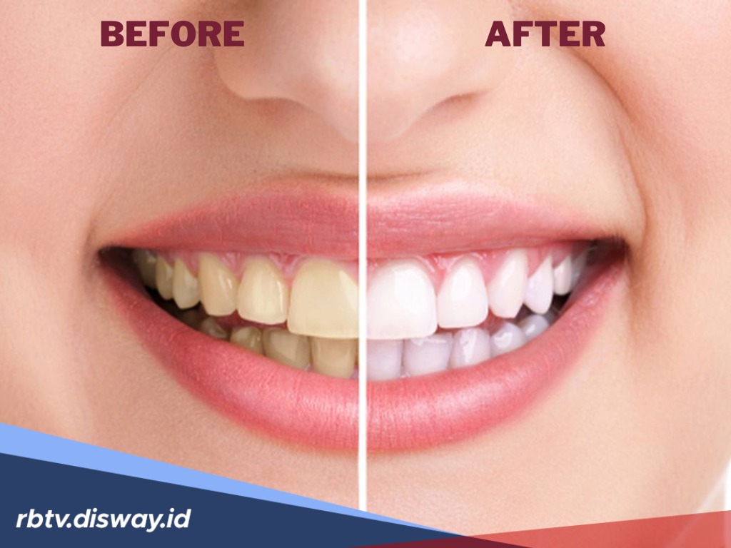 Malu Ketawa karena Gigi Kuning, Coba Putihkan dengan 6 Tanaman Obat Keluarga Berikut