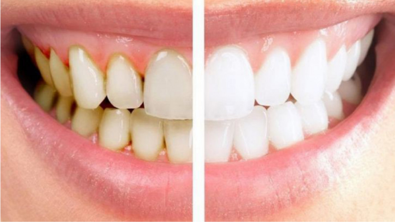 Ada Cara Mudah Membersihkan Karang Gigi tanpa Harus ke Dokter, Tidak hanya Rutin Sikat Gigi
