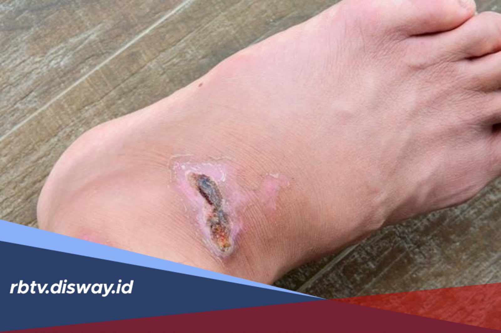 Ini Rahasianya dan Perawatan Menghilangkan Koreng di Kaki
