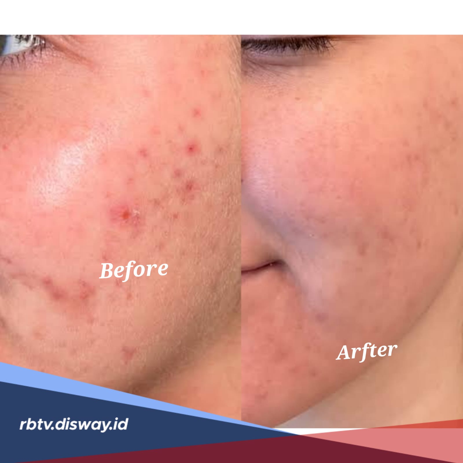 Rahasia Wajah Mulus, Ini Cara Menghilangkan Jerawat dengan Bahan Alami