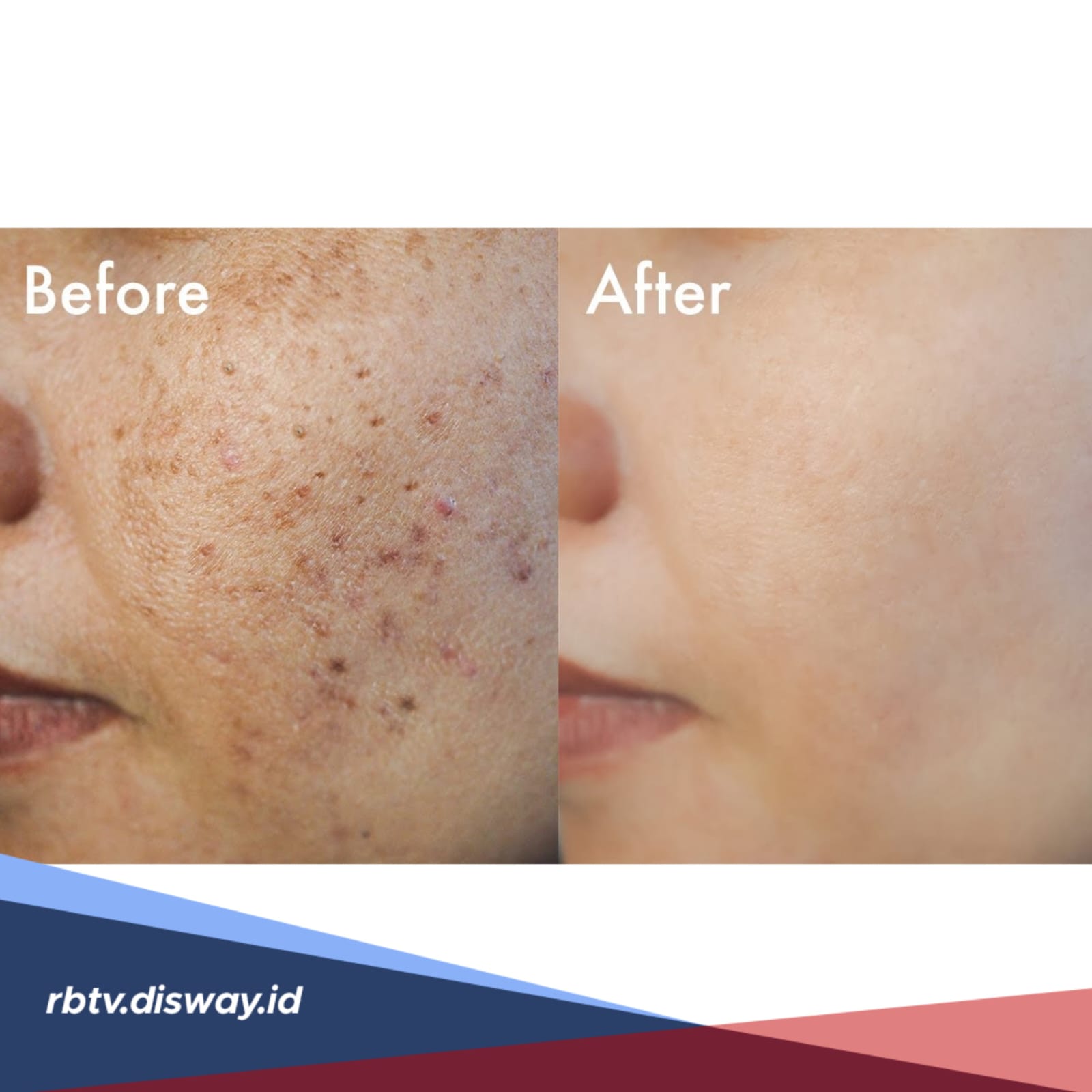 Cara Ampuh Menghilangkan Bopeng di Wajah, Bikin Tampil Lebih Percaya Diri