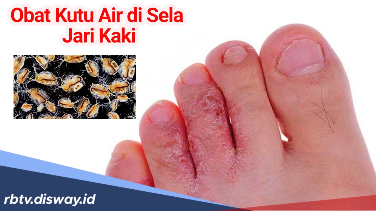 4 Obat Kutu Air di Sela Jari Kaki, Bisa Pakai Bumbu Dapur