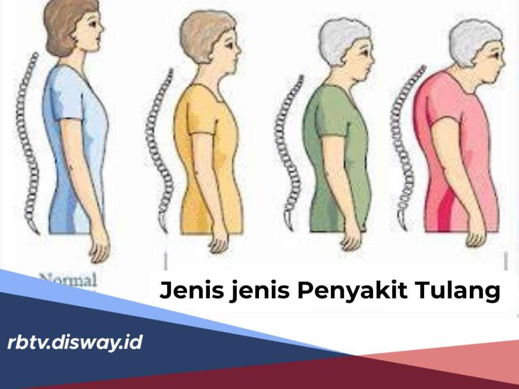 10 Jenis Penyakit Tulang yang Sering Terjadi, Berikut Cara Ampuh Mencegahnya