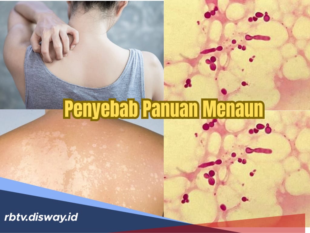 5 Faktor Penyebab Penyakit Kulit Seperti Panu di Tubuh yang Menahun Tidak Sembuh