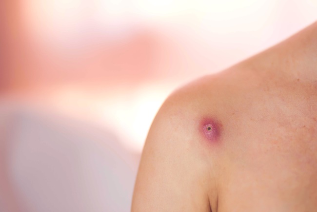 Bisul Bikin Hidup Tidak Nyaman, ternyata Bisa Diobati Pakai Bawang dan Garam