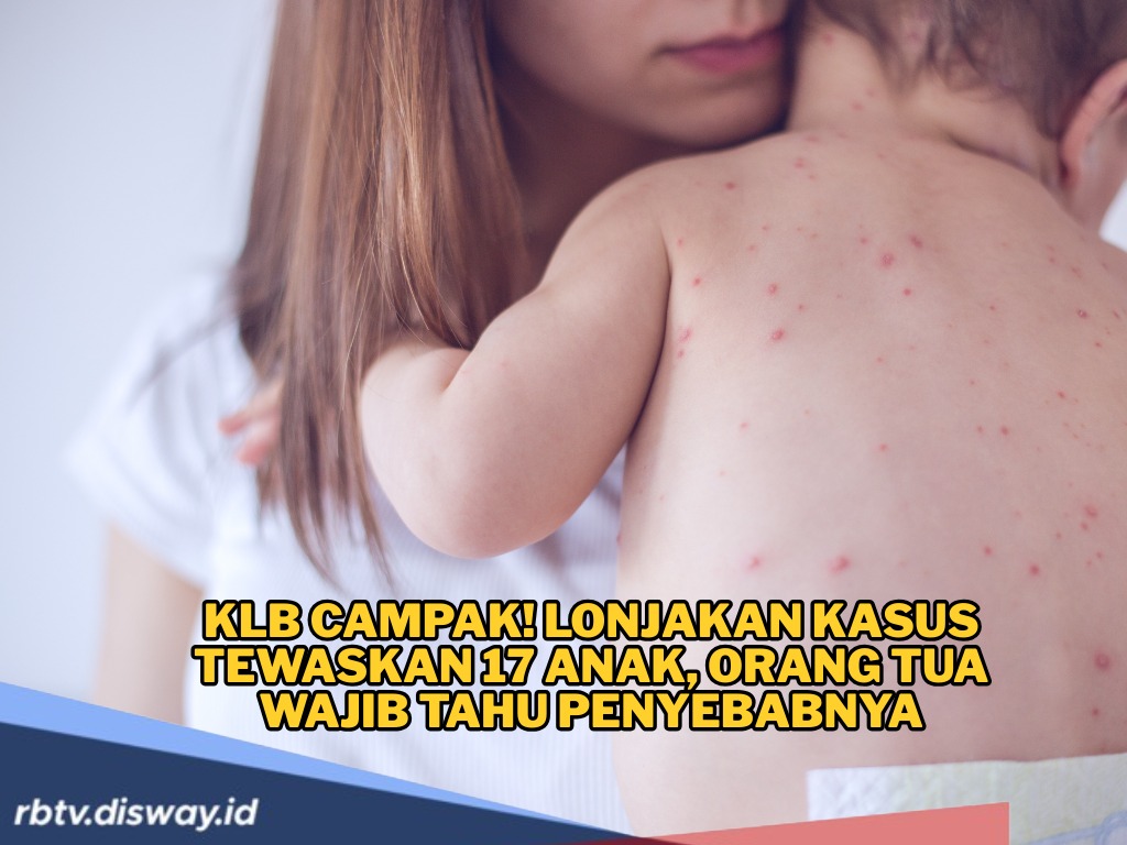 KLB Campak Semakin Ganas, Sebenarnya Apa Itu Campak? Kenali Gejalanya