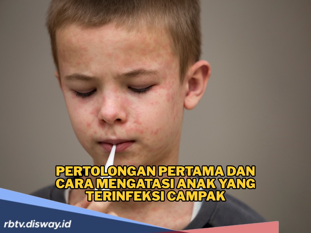 Kasus Campak Tinggi di Jawa Timur, Ini Pertolongan Pertama yang Bisa Dilakukan