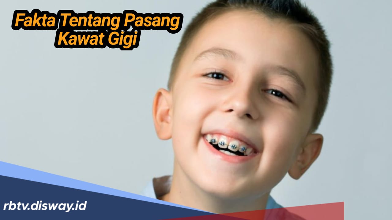 Penting, Ini Fakta Tentang Penggunaan Kawat Gigi Pada Anak  