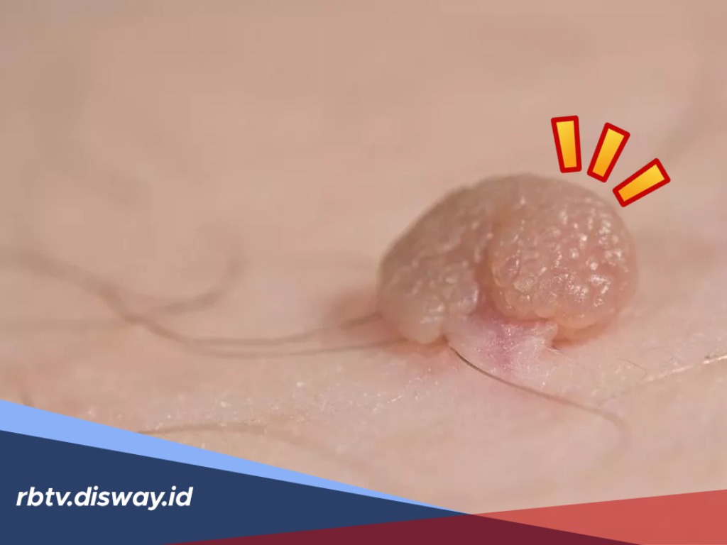 5 Cara Alami Menghilangkan Kutil yang Buat Kamu Kurang Pede