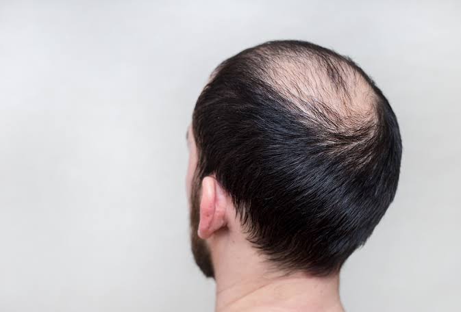 Gak Perlu Transplantasi Rambut, Kebotakan Bisa Langsung Ditangani Cukup Gunakan Telur 