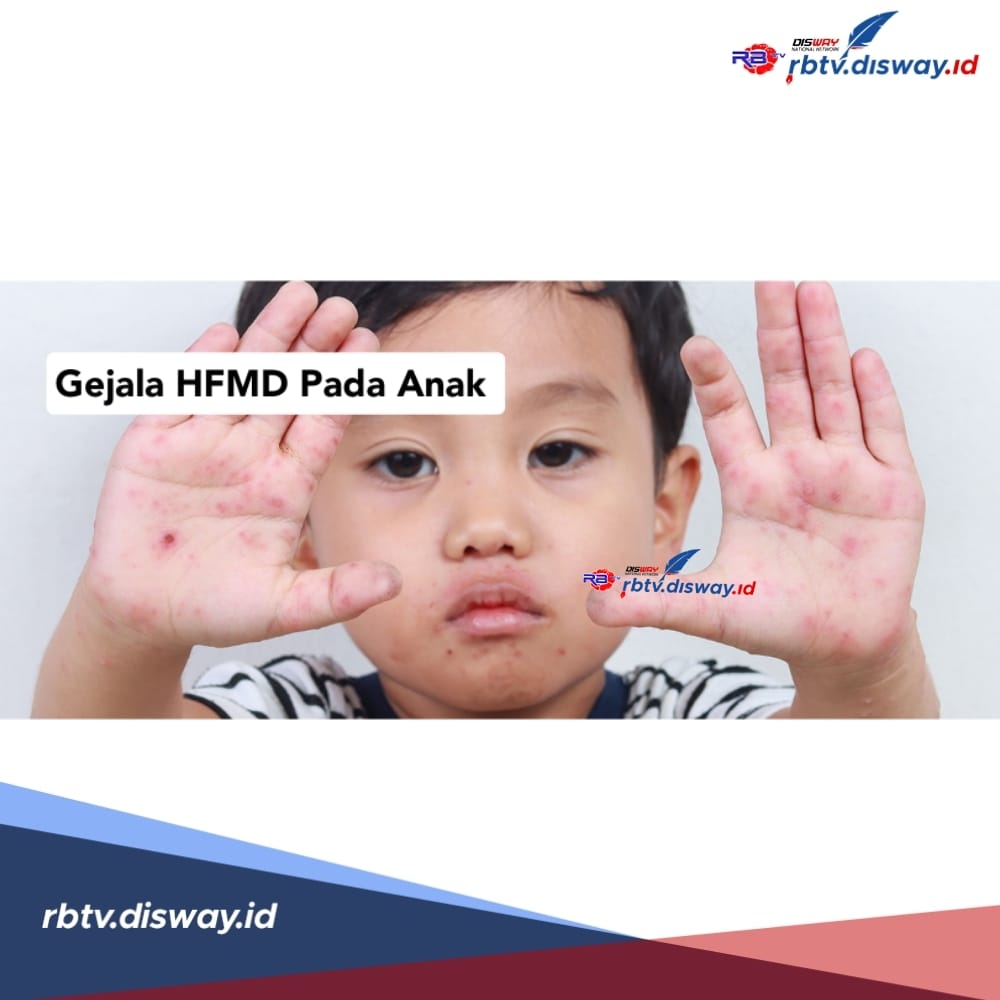 Gejala HFMD atau Flu Singapura pada Anak, Ini Langkah yang Harus Ibu ...