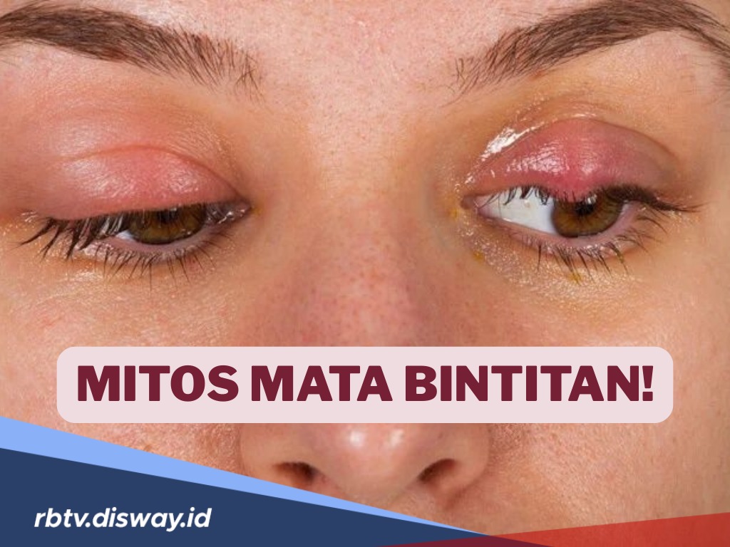 Mata Bintitan Bukan Mitos, Simak Apa Penyebab Mata Bintitan 