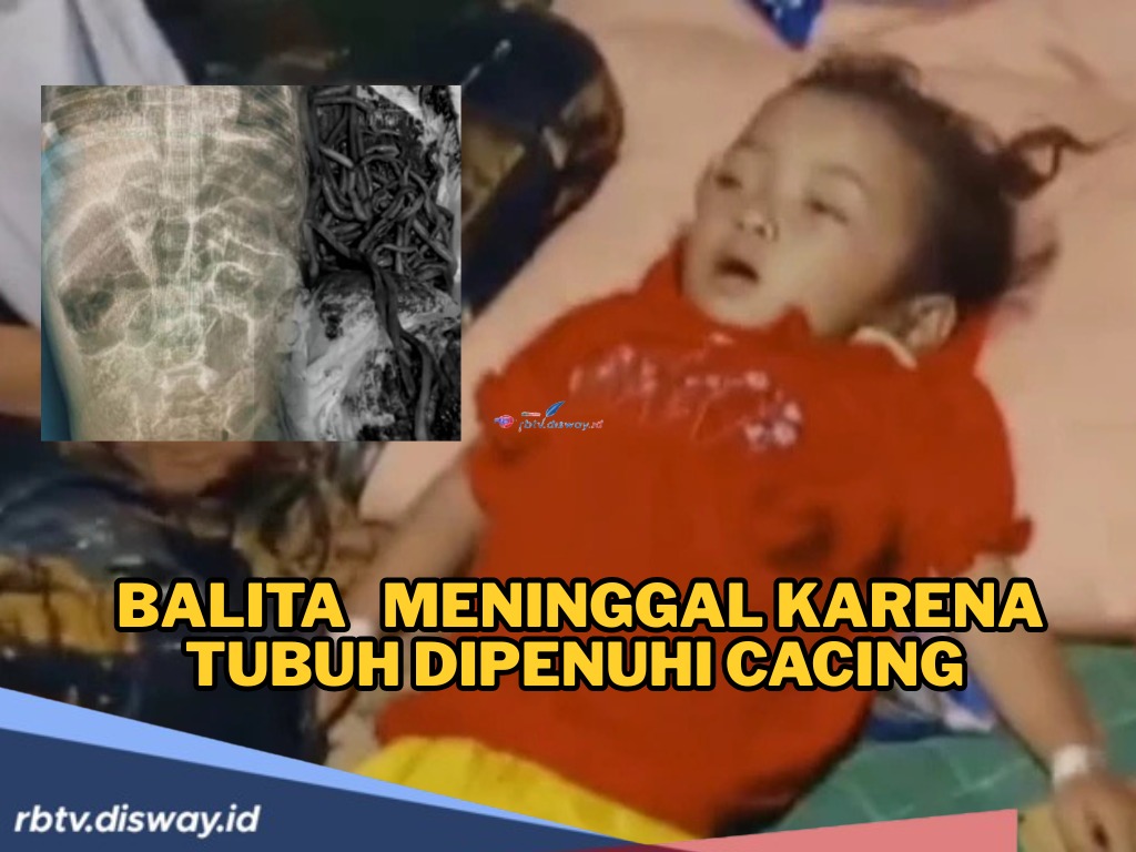 Kisah Pilu Raya, Balita yang Meninggal dengan Tubuh Dipenuhi Cacing, Ini Penyebabnya