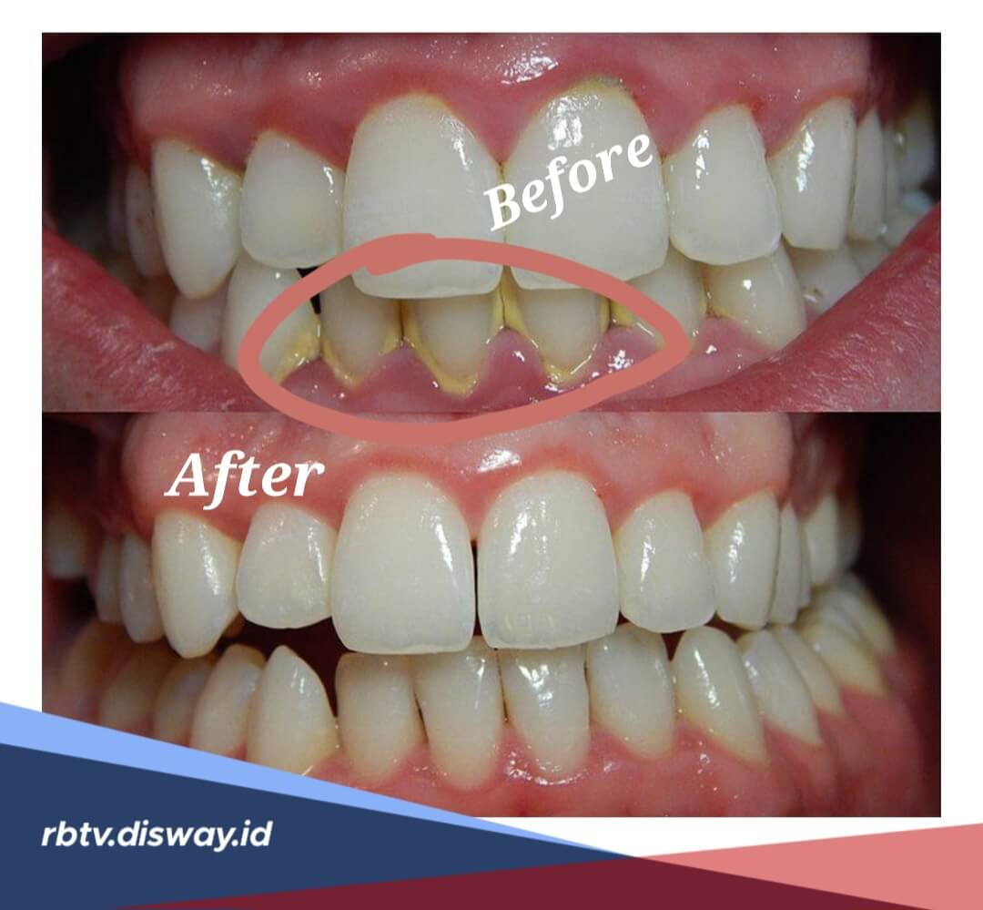 Bukan Sulap, Ini Cara Menghilangkan Karang Gigi Membandel Secara Alami 