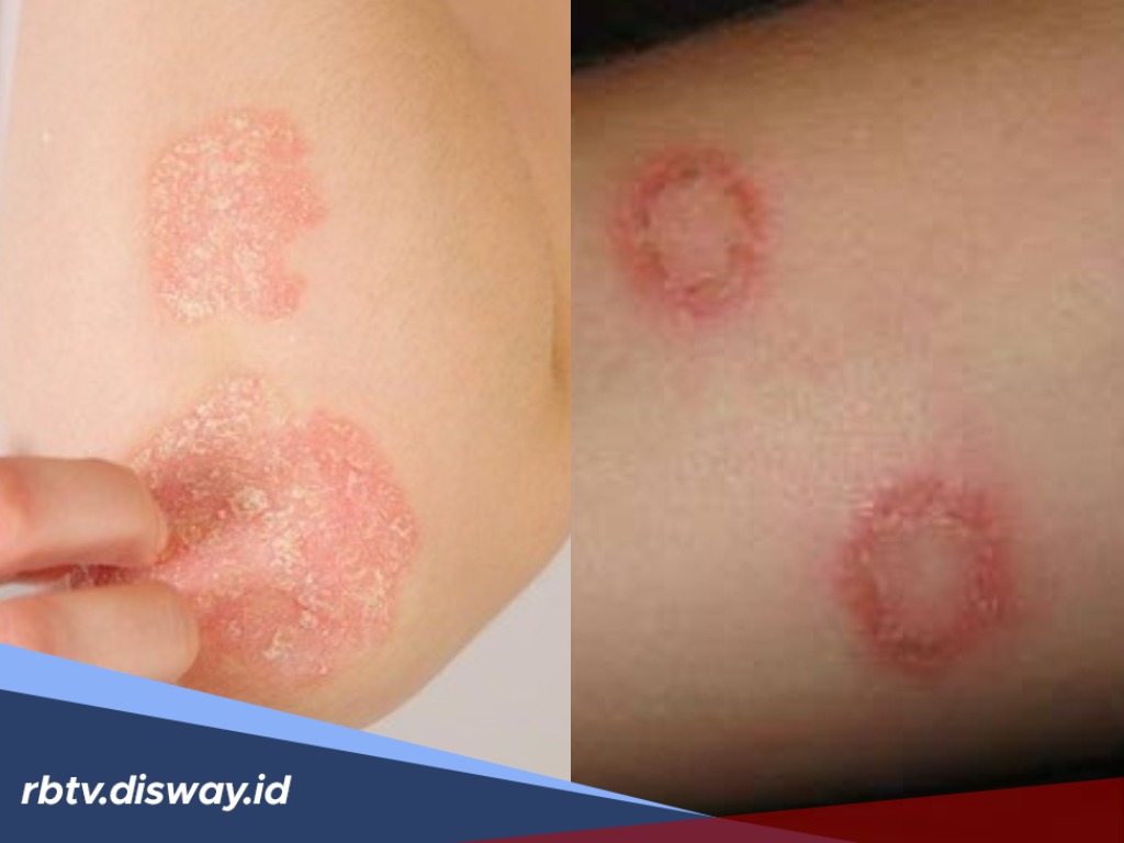 4 Jenis Tanaman Obat Keluarga yang Bisa Dijadikan Obat Gatal Akibat Kurap 