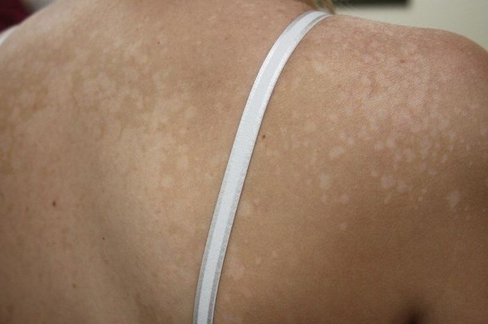 Panu Bikin Percaya Diri Hilang, Ini 7 Obat Panu yang Direkomendasi Para Dokter