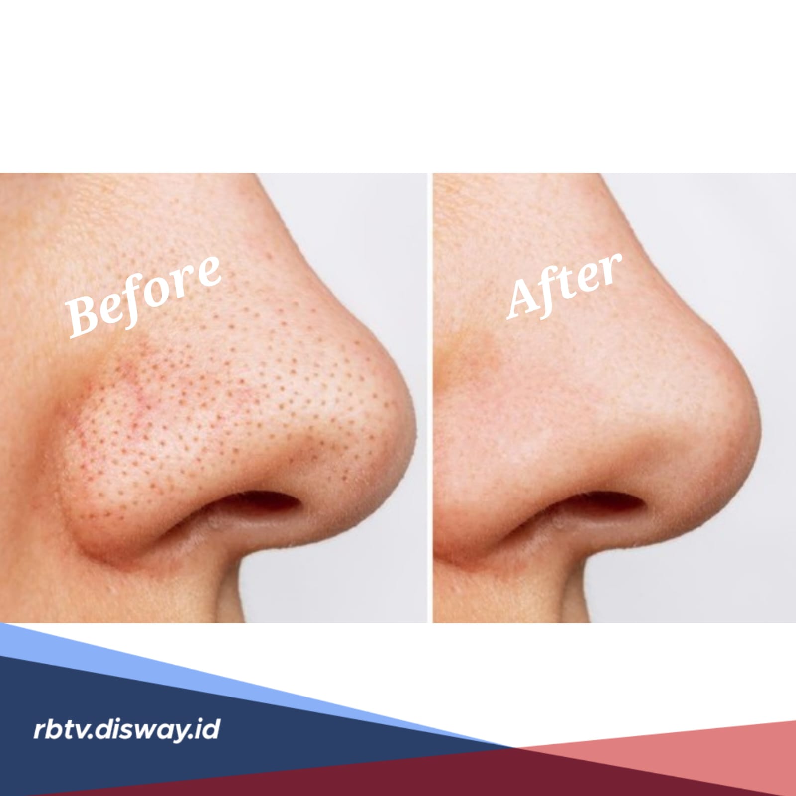 Bukan Dipencet, Begini Cara Menghilangkan Komedo dengan Bahan Alami