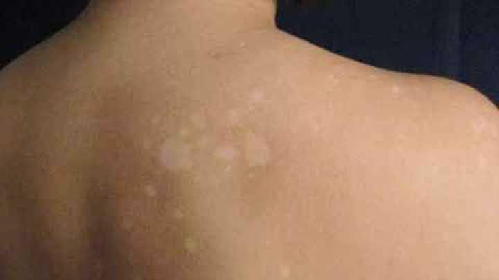 Malunya Sampai ke Ubun-ubun Karena Ada Panu, Tenang Ini 11 Tanaman Obat Keluarga untuk Panu