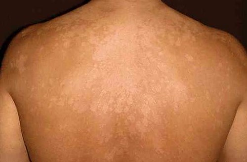 Malu Menampakan Wajah karena Panu? Atasi dengan Tanaman Obat Keluarga Belimbing Wuluh