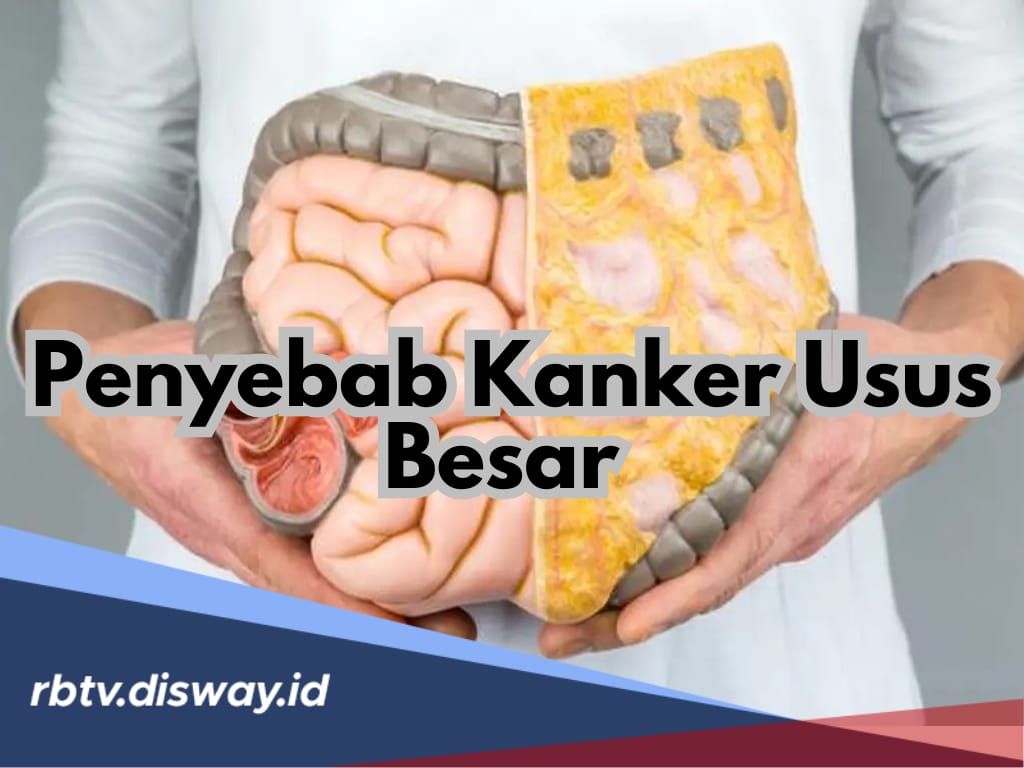 12 Penyebab Kanker Usus Besar, Penyakit Berbahaya yang Sering Diabaikan