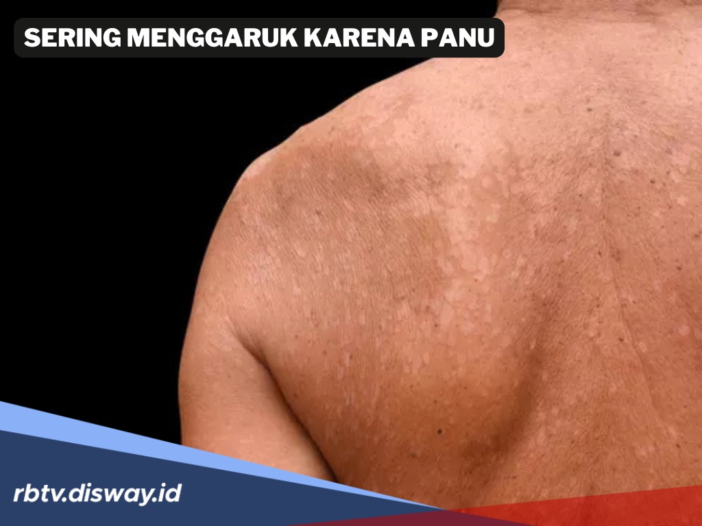 Sering Garuk Karena Gatal-gatal Akibat Panu, Basmi Panu dengan 11 Tanaman Obat Keluarga Berikut