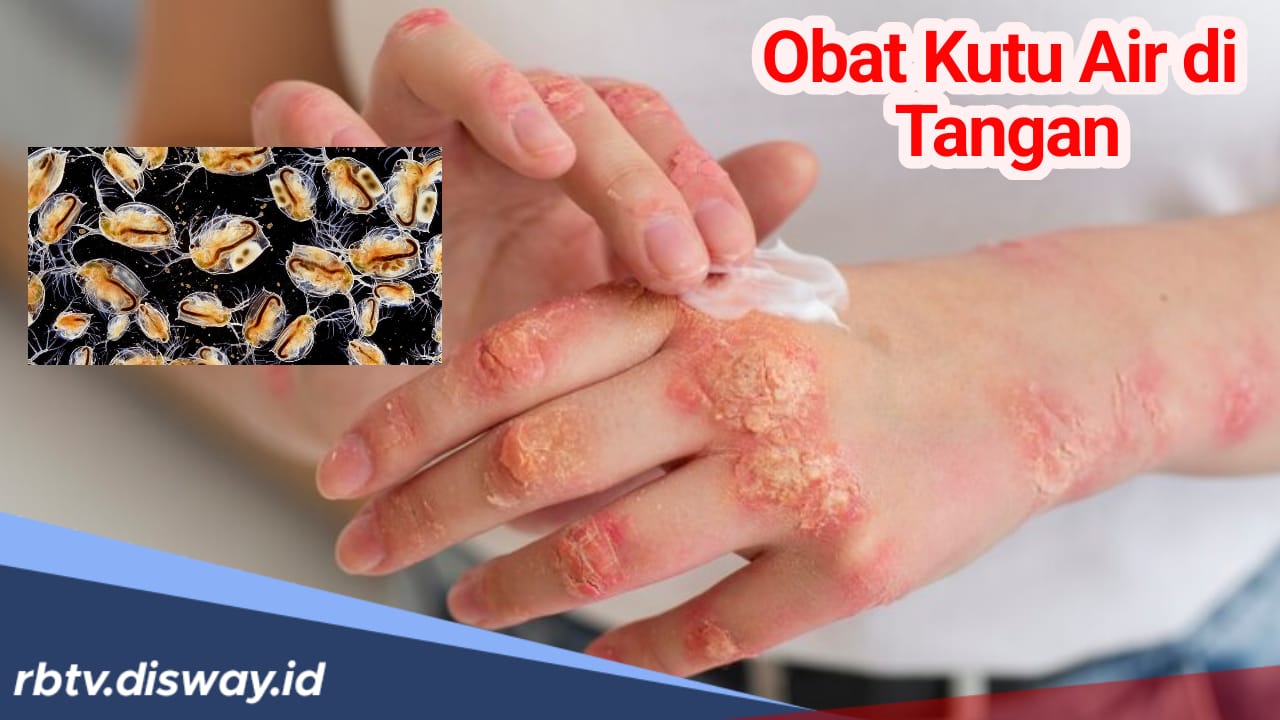 7 Jenis Obat Kutu Air Ditangan yang Ampuh, Mudah Didapat dan Harganya Murah