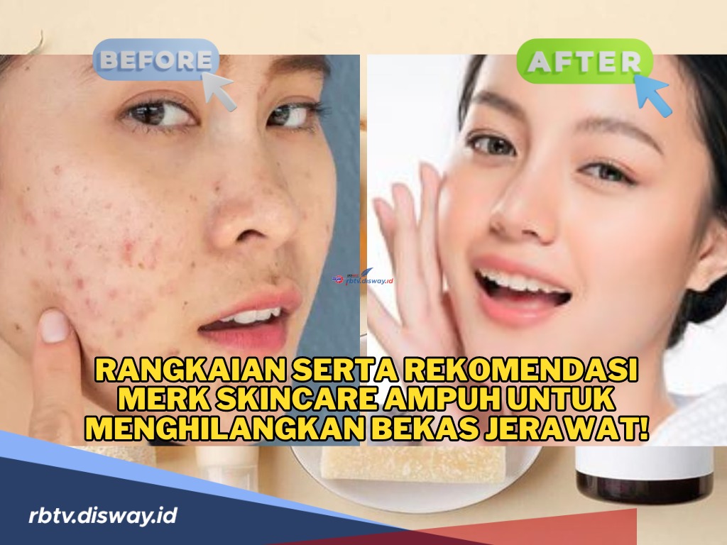 Ini Rekomendasi Merek Skincare Ampuh untuk Menghilangkan Bekas Jerawat, Harga Ramah Dikantong