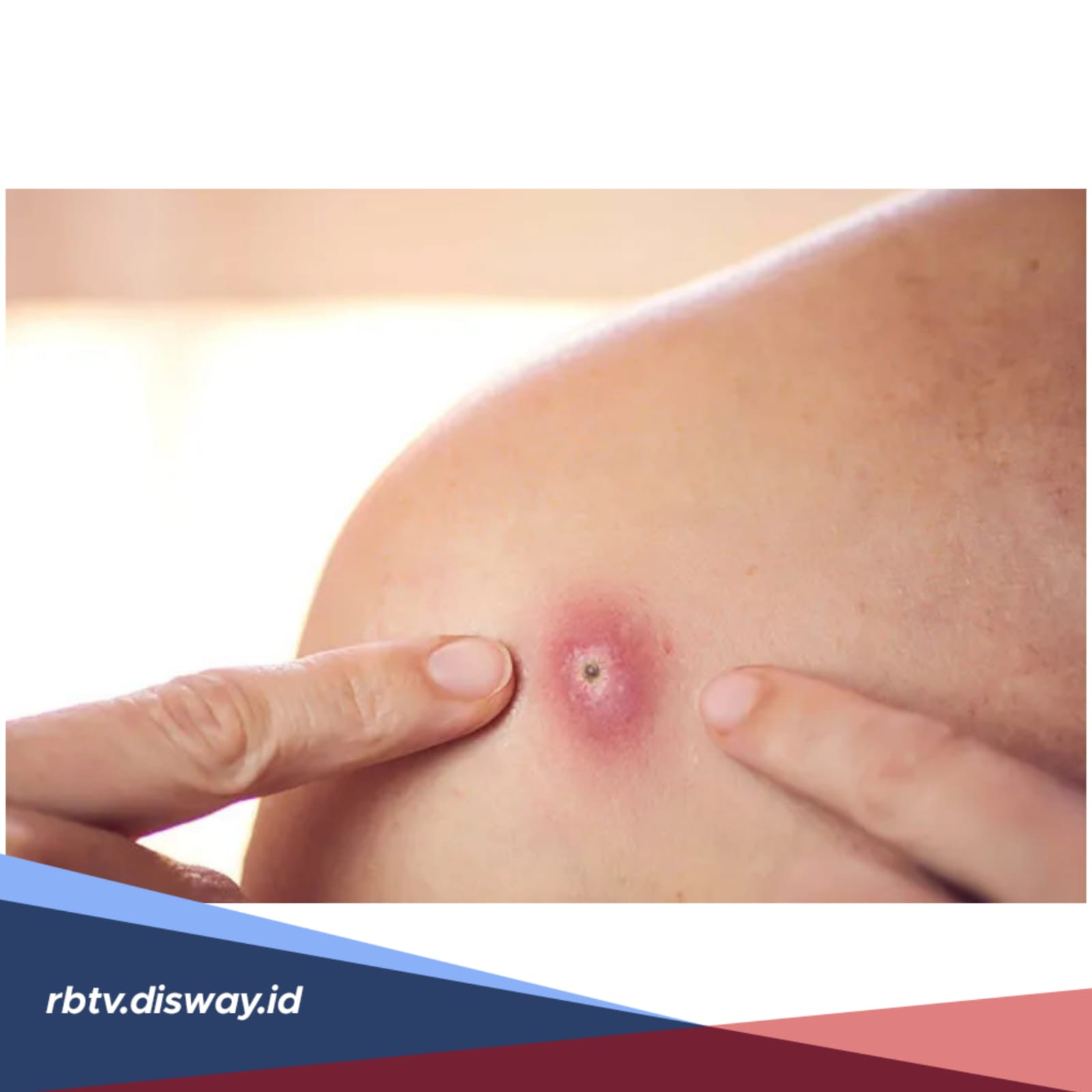 4 Cara Mengobati Bisul dengan Bahan Alami, Dijamin Kempes