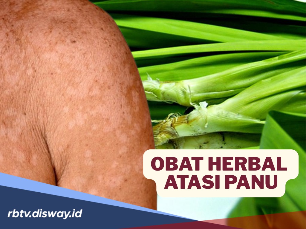 Tak Perlu Salap, Coba Gunakan Obat Herbal Alami Ini untuk Atasi Panu, Paling Ampuh dan Hemat