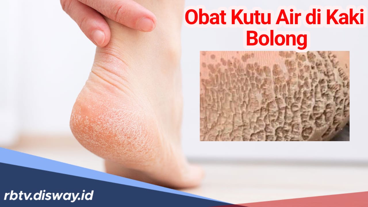 Obat Kutu Air di Kaki jika Sampai Bolong, Bisa Langsung Dicoba 