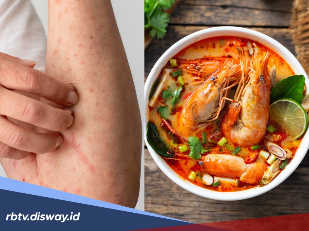 Gatal Usai Makan Udang? Inilah Fakta Alergi yang Perlu Kamu Tahu